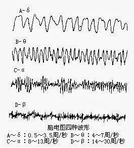 出现脑电图异常波怎么回事?